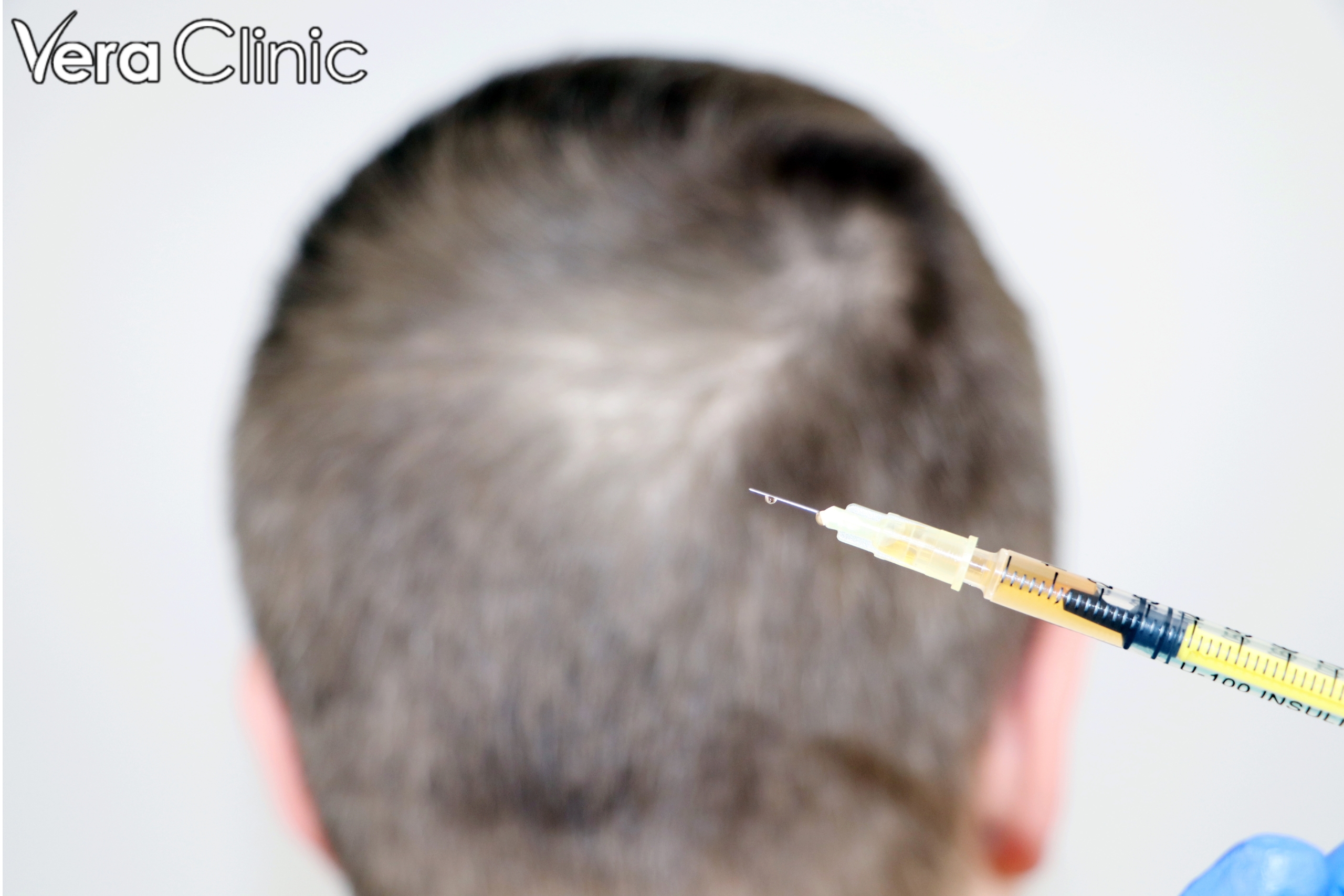 best hair transplant in turkey